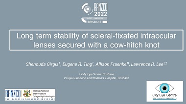 Long term stability of scleral-fixated intraocular lenses secured with a cow-hitch knot