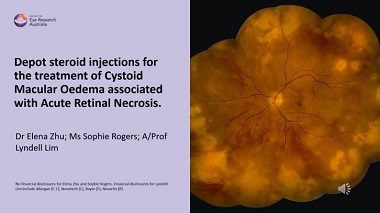 Depot steroid injections for the treatment of Cystoid Macular Oedema associated with Acute Retinal Necrosis.