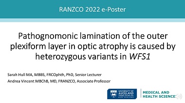 Pathognomonic lamination of the outer plexiform layer in optic atrophy is caused by heterozygous variants in WFS1