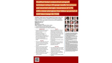 Modified Limbal-Conjunctival Autograft Technique using a 23-gauge needle for Primary and Recurrent Pterygium Surgery: Long-term follow-up results of recurrence and complications