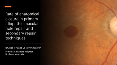 RATE OF ANATOMICAL CLOSURE IN PRIMARY IDIOPATHIC MACULAR HOLE REPAIR AND SECONDARY REPAIR TECHNIQUES